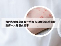 我的左侧腰上面有一块癣 左边腰上起疙瘩特别痒一片是怎么回事