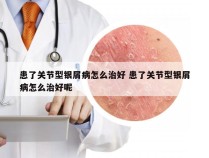 患了关节型银屑病怎么治好 患了关节型银屑病怎么治好呢