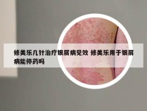 修美乐几针治疗银屑病见效 修美乐用于银屑病能停药吗