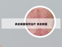 表皮癣菌如何治疗 表皮鲜菌