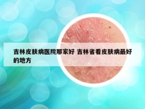 吉林皮肤病医院那家好 吉林省看皮肤病最好的地方