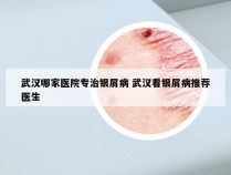 武汉哪家医院专治银屑病 武汉看银屑病推荐医生