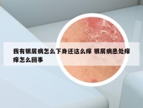 我有银屑病怎么下身还这么痒 银屑病患处痒痒怎么回事