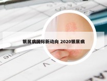 银屑病国际新动向 2020银屑病