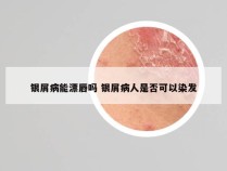 银屑病能漂唇吗 银屑病人是否可以染发