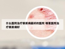 什么医院治疗银屑病最好的医院 哪里医院治疗银屑病好