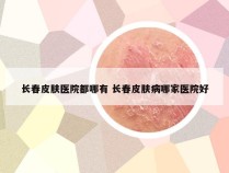 长春皮肤医院都哪有 长春皮肤病哪家医院好