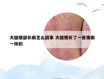 大腿根部长癣怎么回事 大腿根长了一些像癣一样的