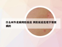 什么叫牛皮癣同形反应 同形反应出现于银屑病的