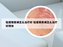 轻度银屑病怎么治疗好 轻度银屑病怎么治疗好得快