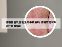 硫磺抑菌乳膏能治疗牛皮癣吗 硫磺软膏可以治疗银屑病吗