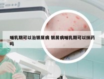 哺乳期可以治银屑病 银屑病哺乳期可以抹药吗