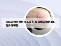 皮肤生物制剂叫什么名字 皮肤病生物制剂打在身体哪里