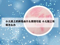 小儿腿上的癣是由什么原因引起 小儿腿上有癣怎么办