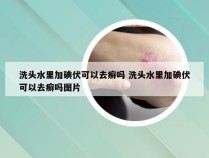 洗头水里加碘伏可以去癣吗 洗头水里加碘伏可以去癣吗图片