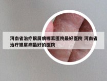 河南省治疗银屑病哪家医院最好医院 河南省治疗银屑病最好的医院