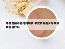 牛皮皮癣不能吃的喝的 牛皮皮癣图片早期症状能治好吗