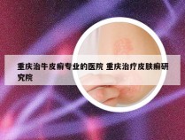 重庆治牛皮癣专业的医院 重庆治疗皮肤癣研究院