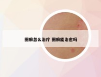 圈癣怎么治疗 圈癣能治愈吗