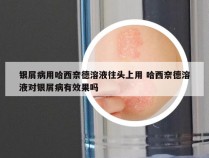 银屑病用哈西奈德溶液往头上用 哈西奈德溶液对银屑病有效果吗