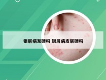 银屑病发硬吗 银屑病皮屑硬吗