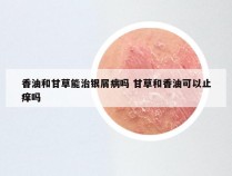 香油和甘草能治银屑病吗 甘草和香油可以止痒吗