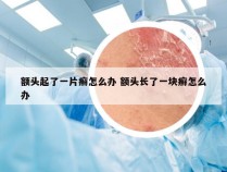 额头起了一片癣怎么办 额头长了一块癣怎么办