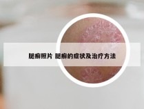 腿癣照片 腿癣的症状及治疗方法