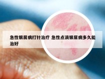 急性银屑病打针治疗 急性点滴银屑病多久能治好