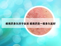 癣用药多久印子会消 癣用药膏一般多久能好