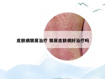 皮肤病银屑治疗 银屑皮肤病好治疗吗