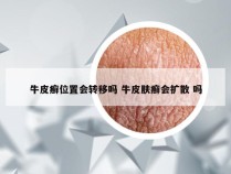 牛皮癣位置会转移吗 牛皮肤癣会扩散 吗