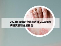 2023银屑病研究最新进展 2023银屑病研究最新进展报告