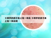 十四岁的孩子身上有一块白 十四岁的孩子身上有一块白斑