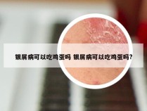 银屑病可以吃鸡蛋吗 银屑病可以吃鸡蛋吗?