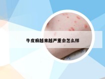 牛皮癣越来越严重会怎么样