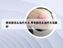 厚皮癣怎么治疗方法 厚皮癣怎么治疗方法最好