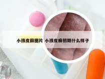 小孩皮藓图片 小孩皮癣初期什么样子