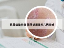 银屑病激素癍 银屑病用激素几天治好