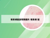 银屑病腿部初期图片 银屑病 腿