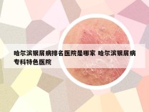 哈尔滨银屑病排名医院是哪家 哈尔滨银屑病专科特色医院