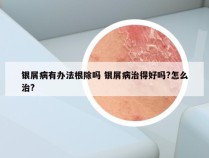 银屑病有办法根除吗 银屑病治得好吗?怎么治?