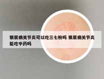 银屑病关节炎可以吃三七粉吗 银屑病关节炎能吃中药吗