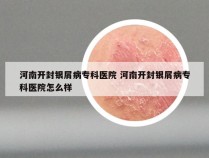 河南开封银屑病专科医院 河南开封银屑病专科医院怎么样