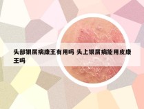 头部银屑病康王有用吗 头上银屑病能用皮康王吗