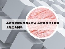 手背皮肤有很多白色斑点 手背的皮肤上有白点是怎么回事