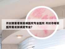 开封那里看银屑病医院专业医院 开封市哪家医院看皮肤病更专业?