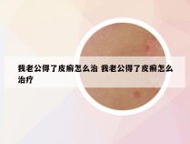 我老公得了皮癣怎么治 我老公得了皮癣怎么治疗