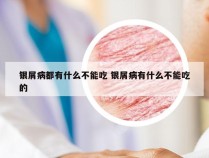 银屑病都有什么不能吃 银屑病有什么不能吃的