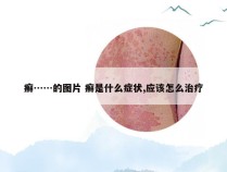 癣……的图片 癣是什么症状,应该怎么治疗